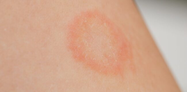 Ringworm-1