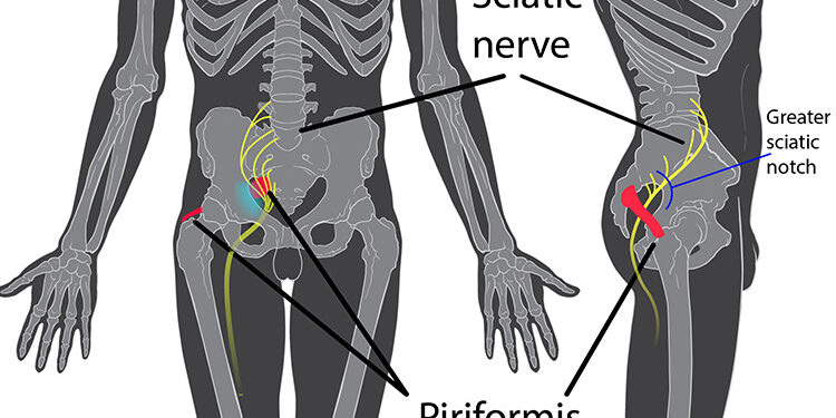 sciatica prevention and treatment