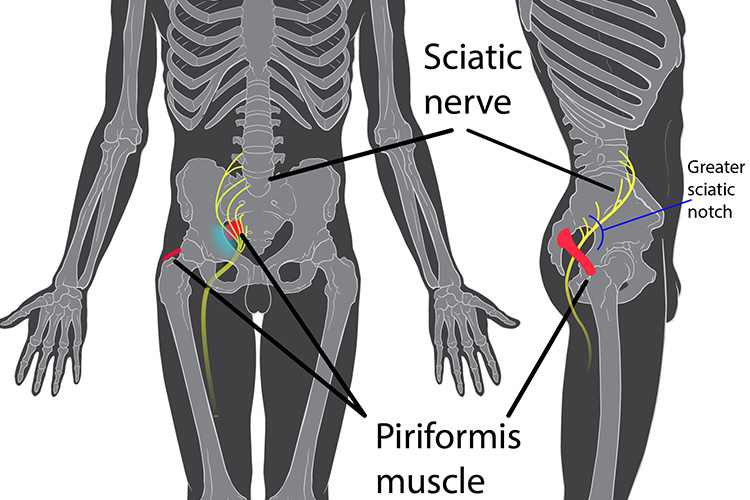 sciatica prevention and treatment